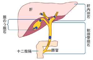 胆石のできる場所